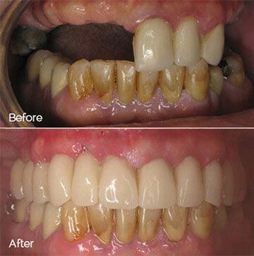 Before and After Dental Implant Photo
