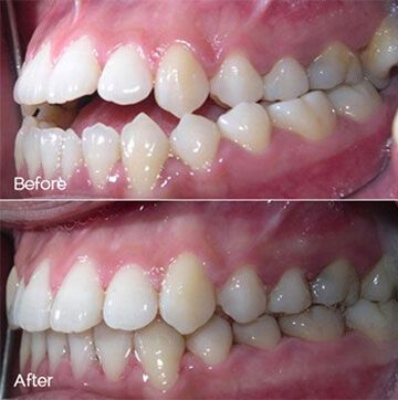 Before and After Orthodontics Photo