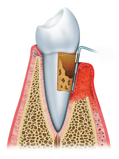 Gum Disease | Clock Tower Dental