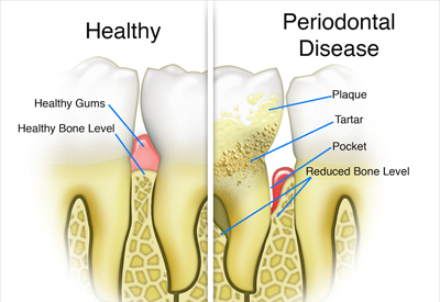 Gum Disease | Clock Tower Dental