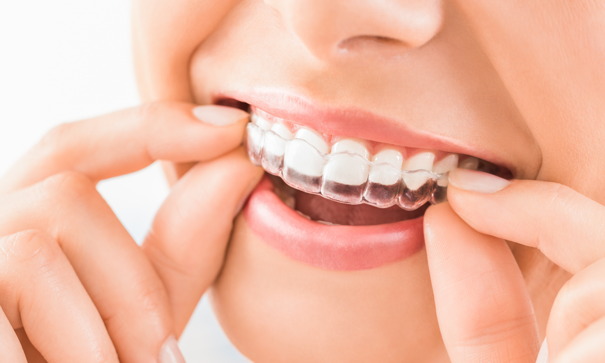 Invisalign: Your Path to a Stunning Smile